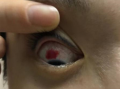 为什么戴美瞳眼睛烧，为什么戴美瞳眼睛有灼烧感