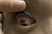 为什么戴美瞳眼睛烧，为什么戴美瞳眼睛有灼烧感