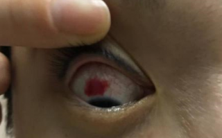 为什么戴美瞳眼睛烧，为什么戴美瞳眼睛有灼烧感