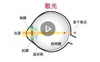 散光如何换算，散光如何换算隐形眼镜度数